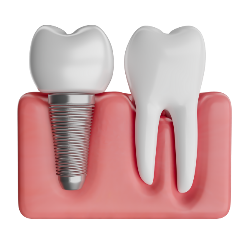 Dental Implants