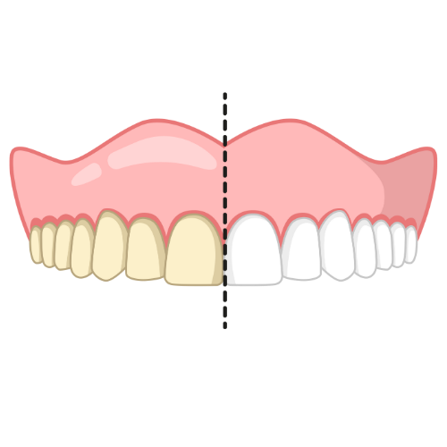 Teeth Whitening