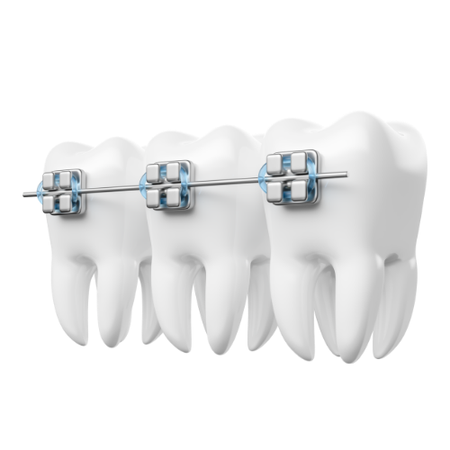 Dental Braces
