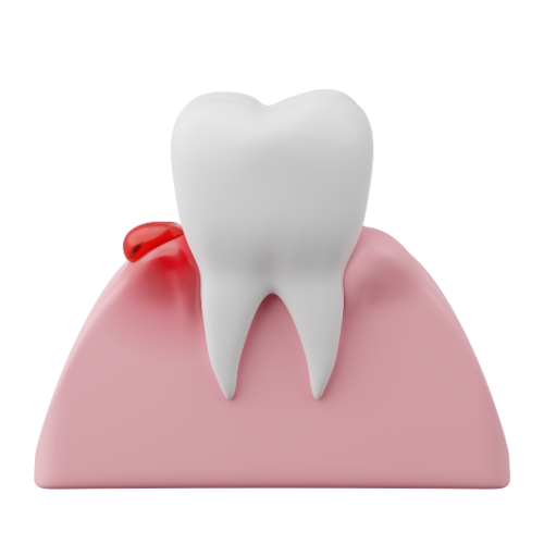 Gums Treatment