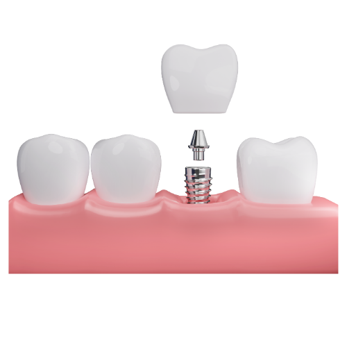 Dental Crowns & Bridges